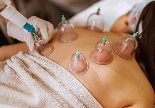 cupping therapy